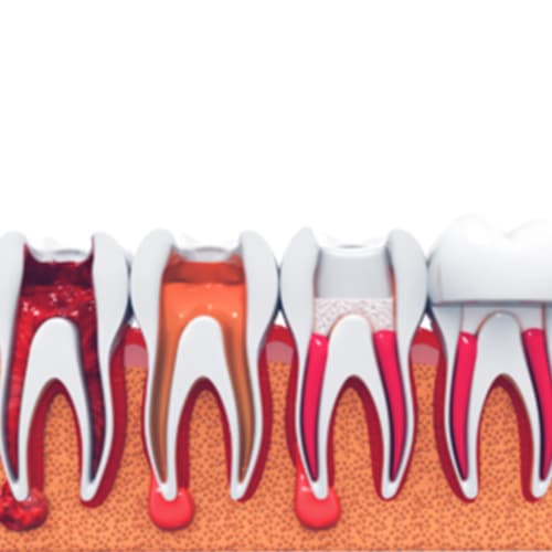 Teeth Whitening Treatment at Gupta Dental Dwarka