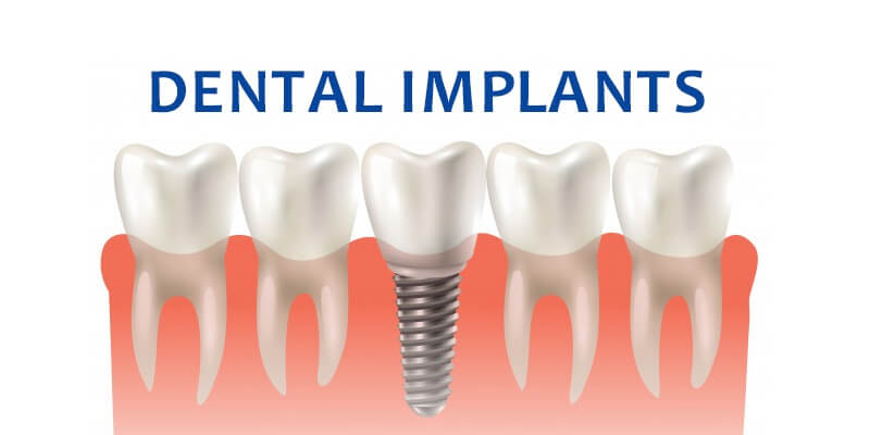 Best Dental Implants - Gupta dental clinic
