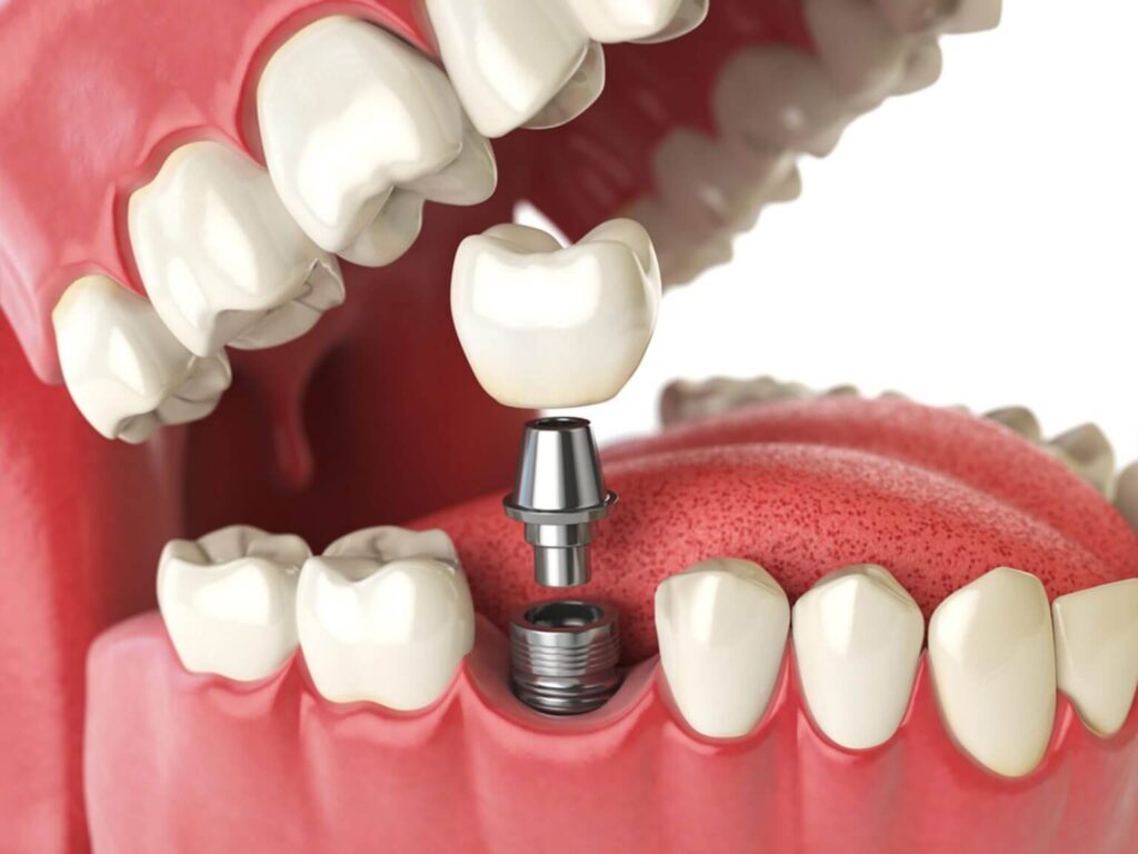 Best Dental Implants - Gupta dental clinic 