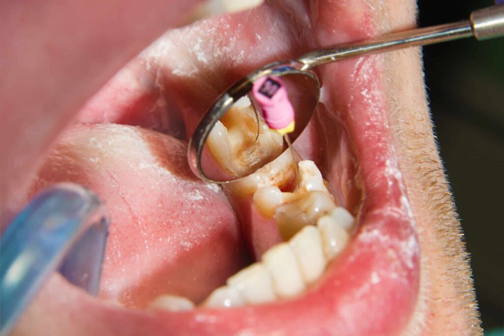 painless root canal treatment in dwarka
