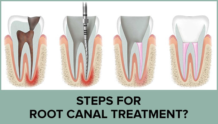 painless root canal treatment in dwarka