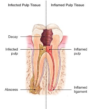 What Takes Place When Getting a Root Canal?